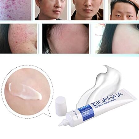 Bioaqua Acne Cream | Bio Aqua Removal Of Acne