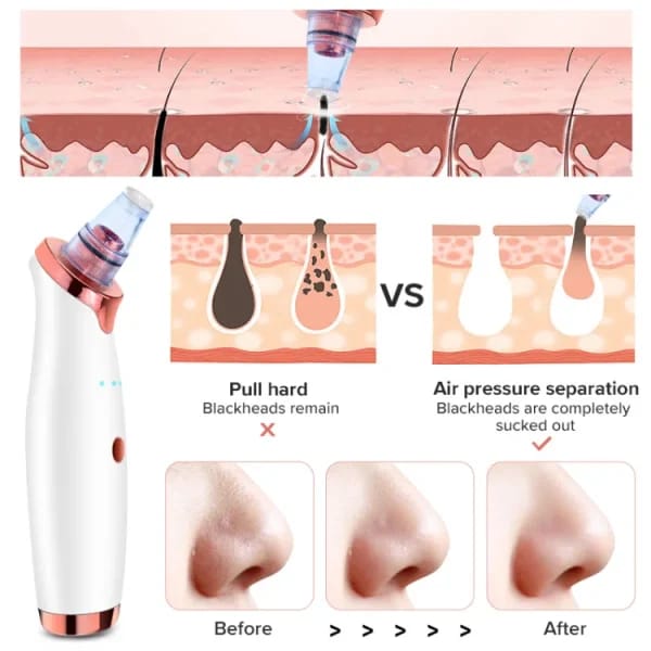 Face Vacuum Blackhead Remover Pore Cleaner | Electric Deep Cleansing Tool For Nose & Face